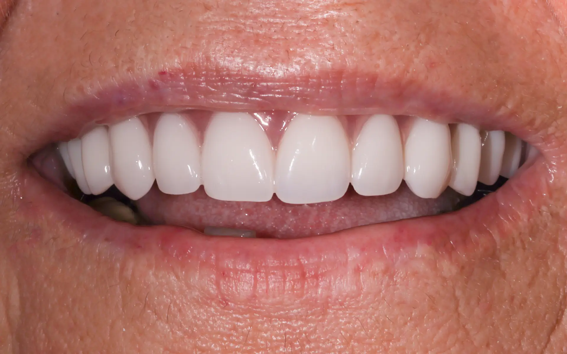 implant-1-After implant-1-After