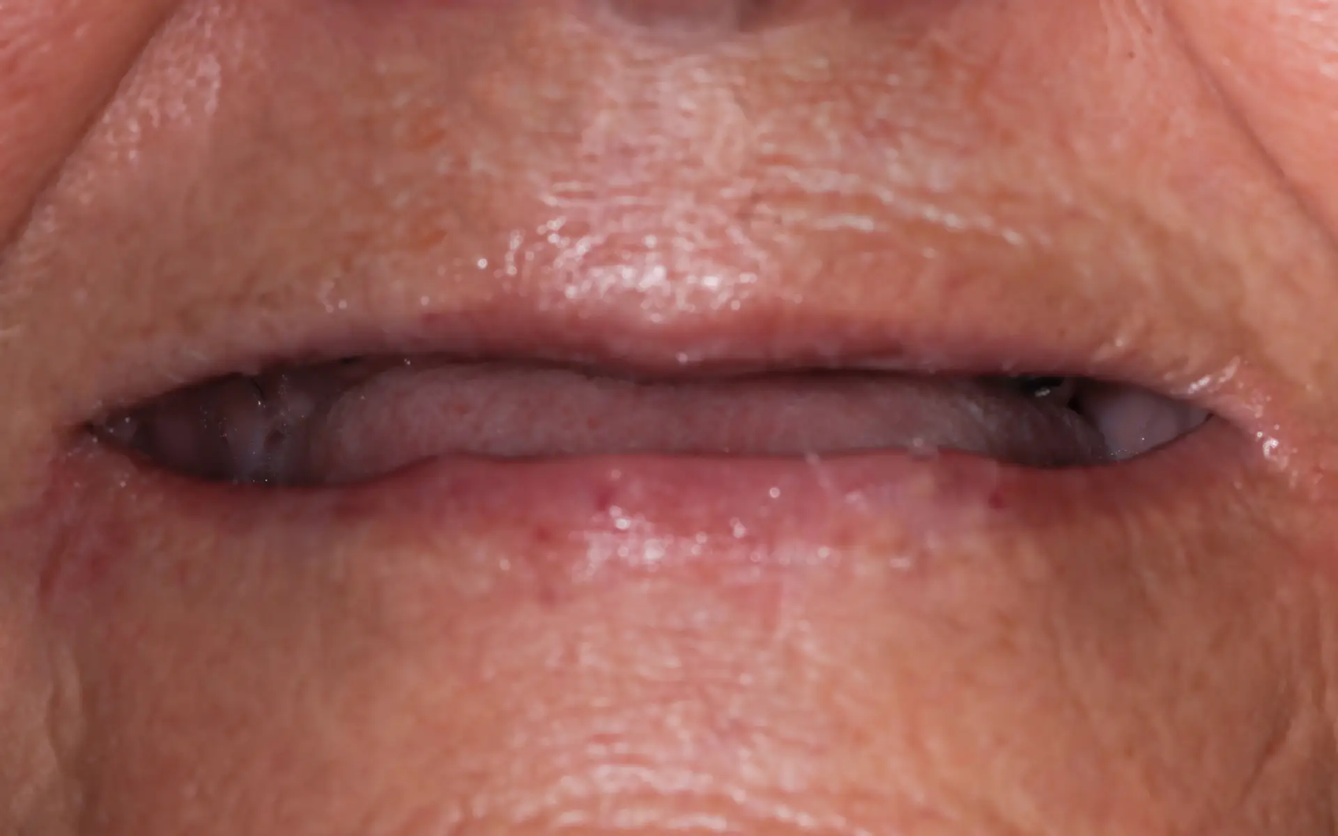 implant-1-Before implant-1-Before