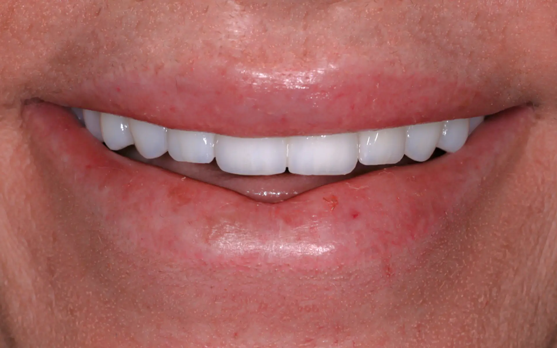 implant-2-After implant-2-After